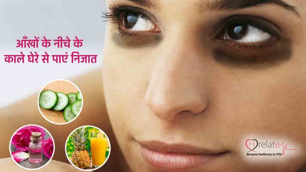 Dark Circles Under Eyes In Hindi आंखों के नीचे होने वाले काले घेरे के