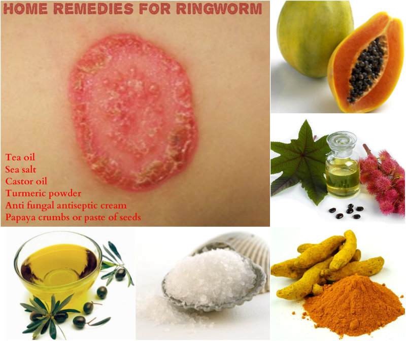 Home Remedies For Ringworm