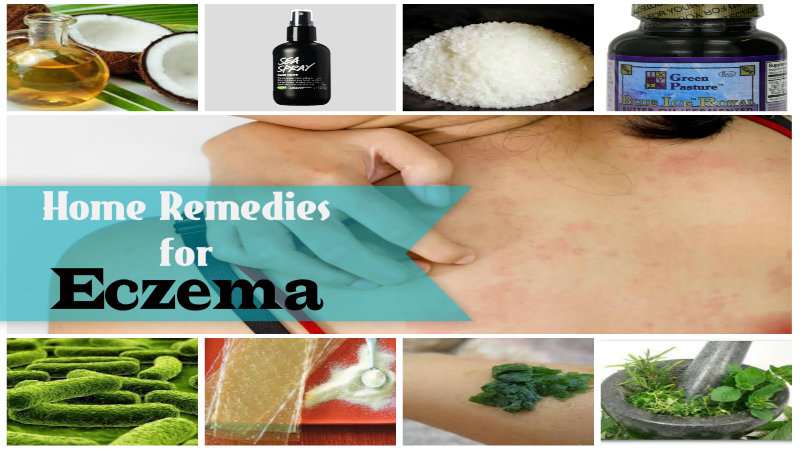 Home-Remedies-for-Eczema