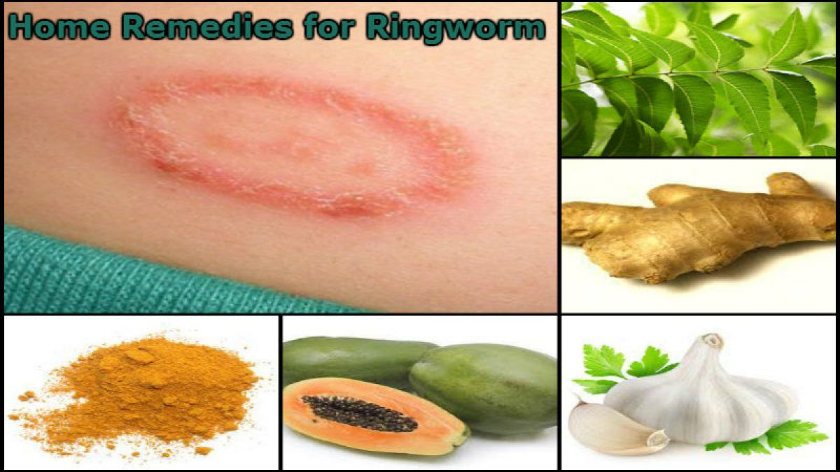 10 Home Remedies for Ringworm Treatment | Credihealth