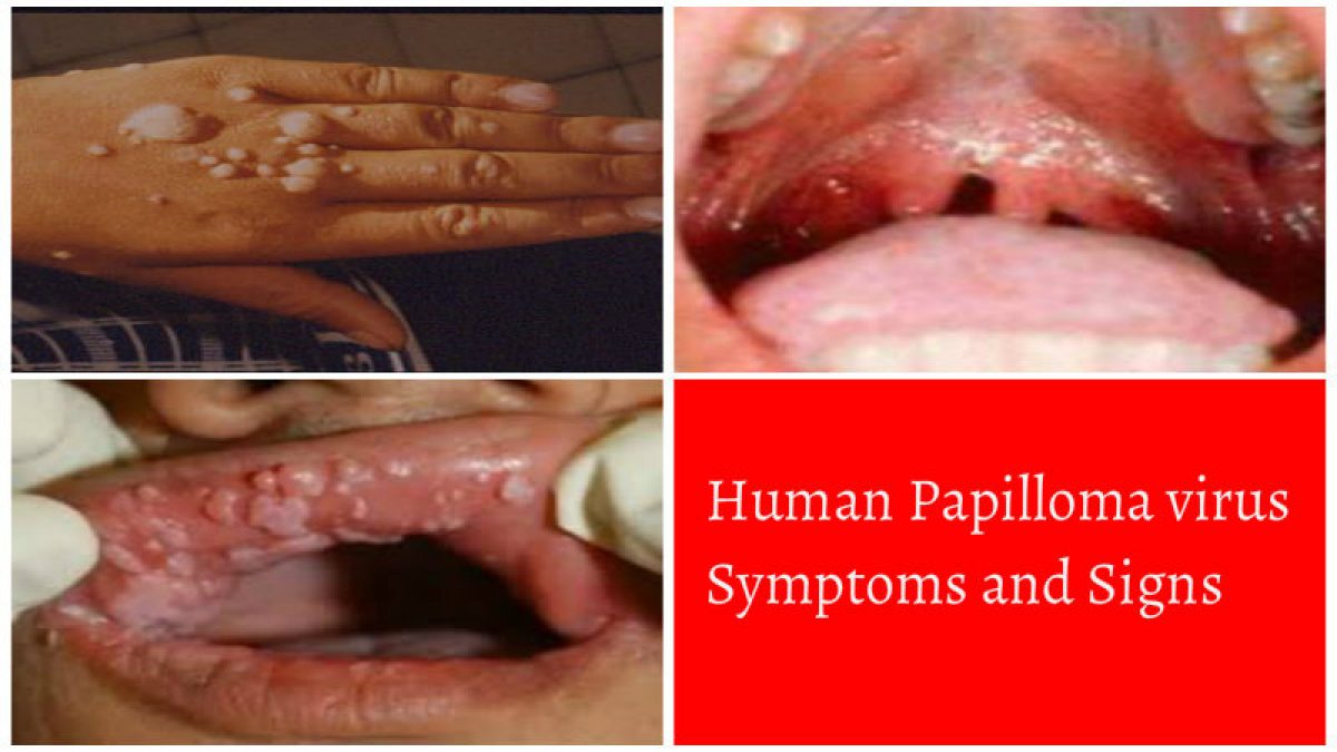 papilloma virus cause psicosomatiche