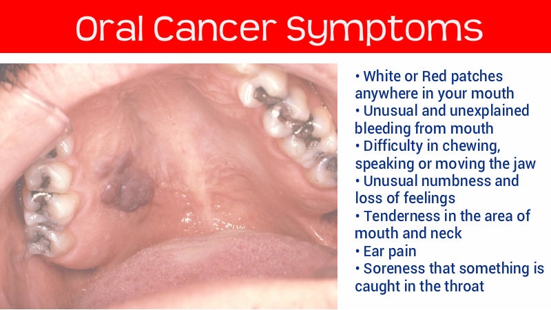 Find Out Oral Cancer Symptoms And Combat With Them
