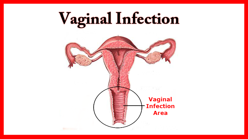 Vaginal Infection