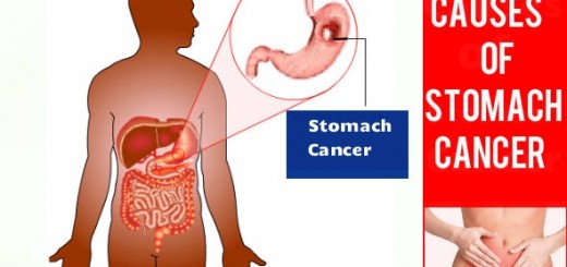 Causes of Stomach Cancer
