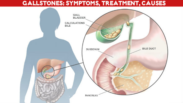 Gallstones Symptoms