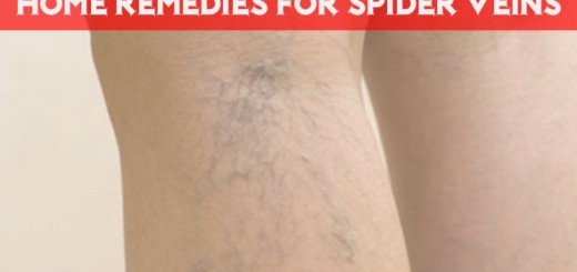 Home Remedies for Spider Veins