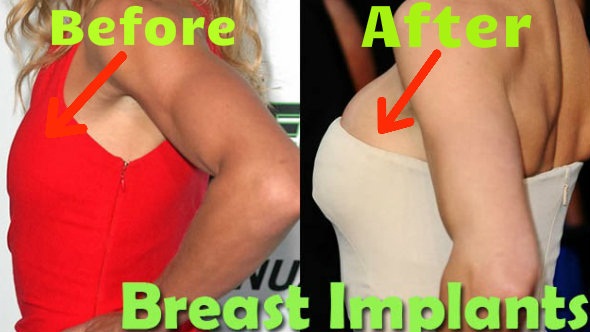 Breast Implants Side Effects