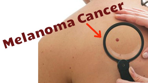 Symptoms and Pictures of Stage 4 Melanoma - Healthline