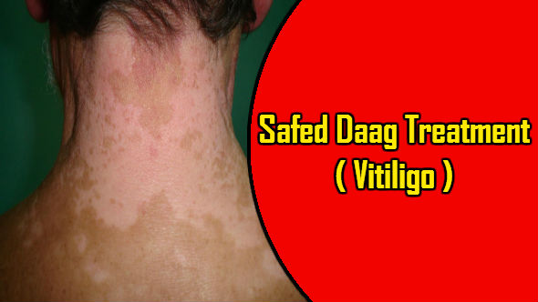 Safed Daag Treatment In Hindi