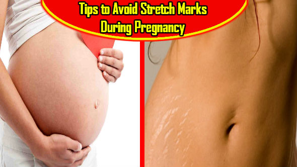 Avoid Stretch Marks During Pregnancy