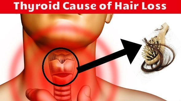 Thyroid Cause of Hair Loss