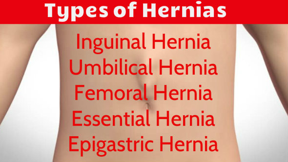 Types of Hernias