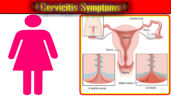 Cervicitis Symptoms in Hindi