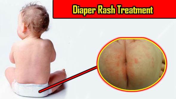 Diaper Rash Treatment in Hindi