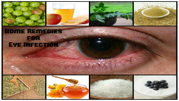 Home Remedies for Eye Infection