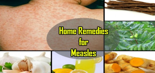 Home Remedies for Measles