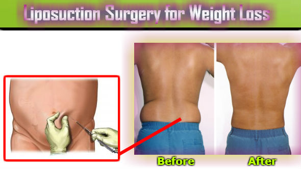Liposuction Surgery for Weight Loss
