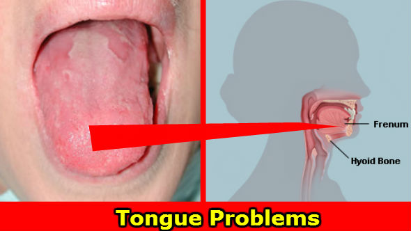 Tongue Problems in Hindi