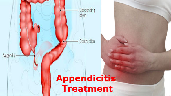 Appendicitis Treatment