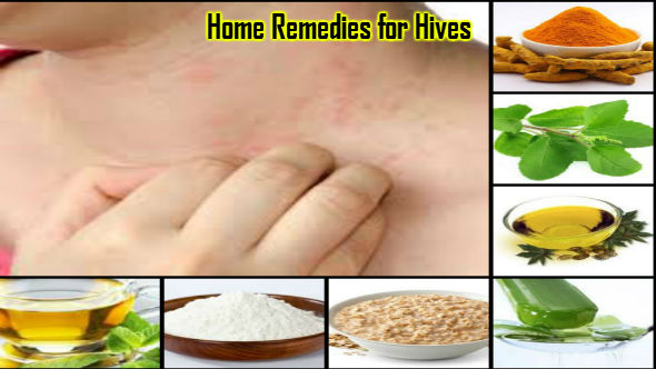 Home Remedies for Hives