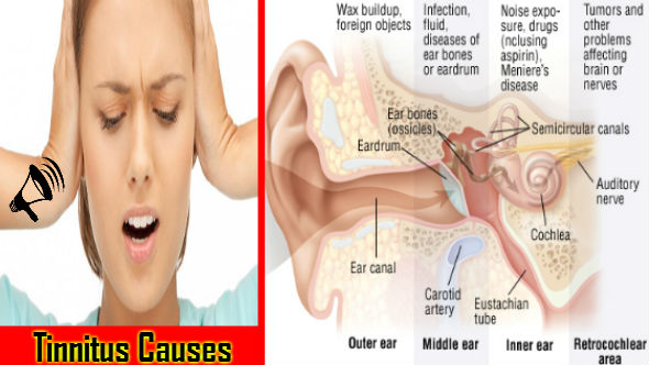 Tinnitus Causes in Hindi