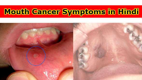 Mouth Cancer symptoms in hindi
