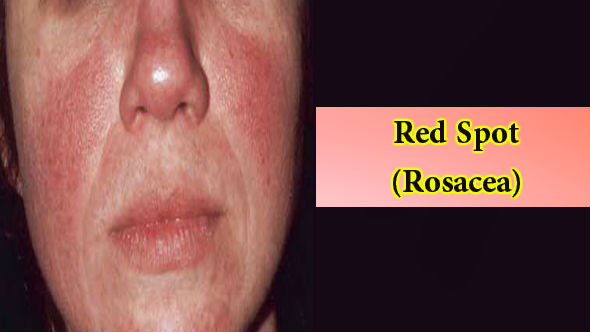 Red Spot-Rosacea