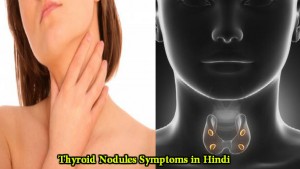 Thyroid Nodules Symptoms Hindi: Janiye Iske Lakshan