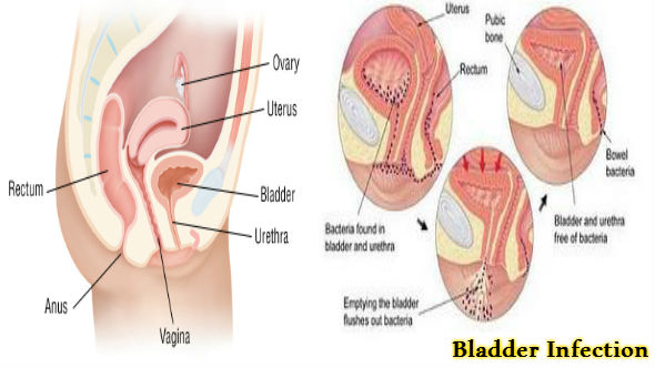 Bladder Infection