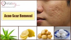 Acne Scar Removal Tips Se Chehre Ke Daag Dhabbe Hataye