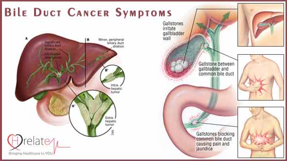 Bile Duct Cancer Symptoms