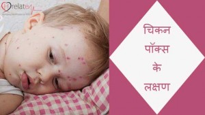 Chicken Pox Symptoms in Hindi: Jane Lakshan aur Upchar
