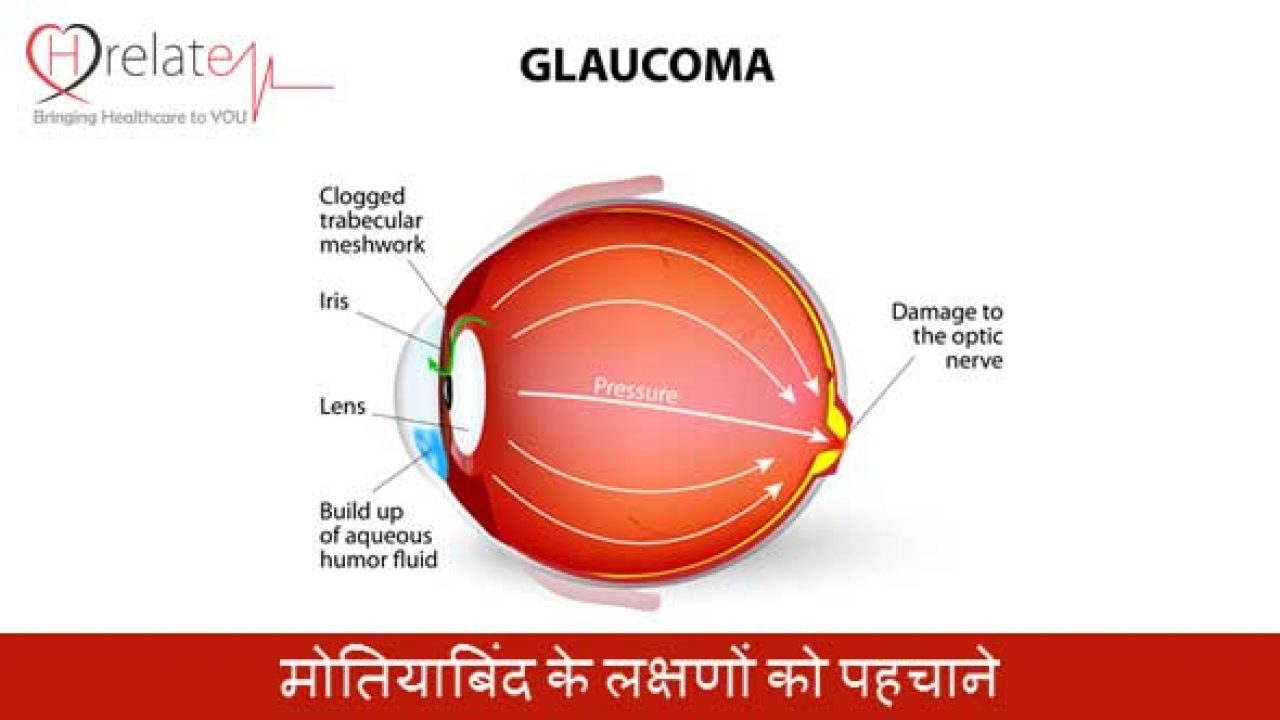Glaucoma Hindi - Astigmatism Glaucoma Swollen Eyes Disease
