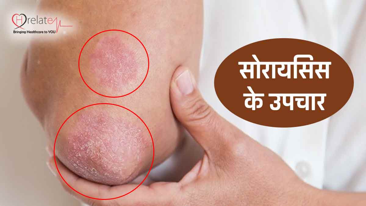 Psoriasis Treatment in Hindi