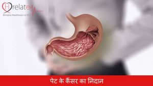 Colon Cancer in Hindi: Kya Hai Pet Ka Cancer aur Iska Nidan