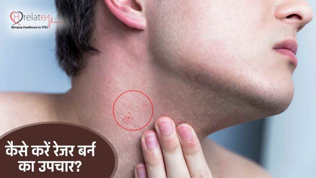 Razor Burn Treatment शेव करते वक्त त्वचा छिल जाने पर ऐसे करें उसका उपचार
