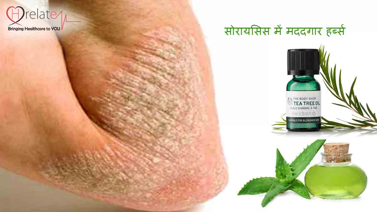 Herbs for Psoriasis